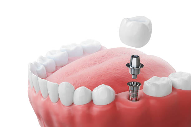 Implantes Dentários